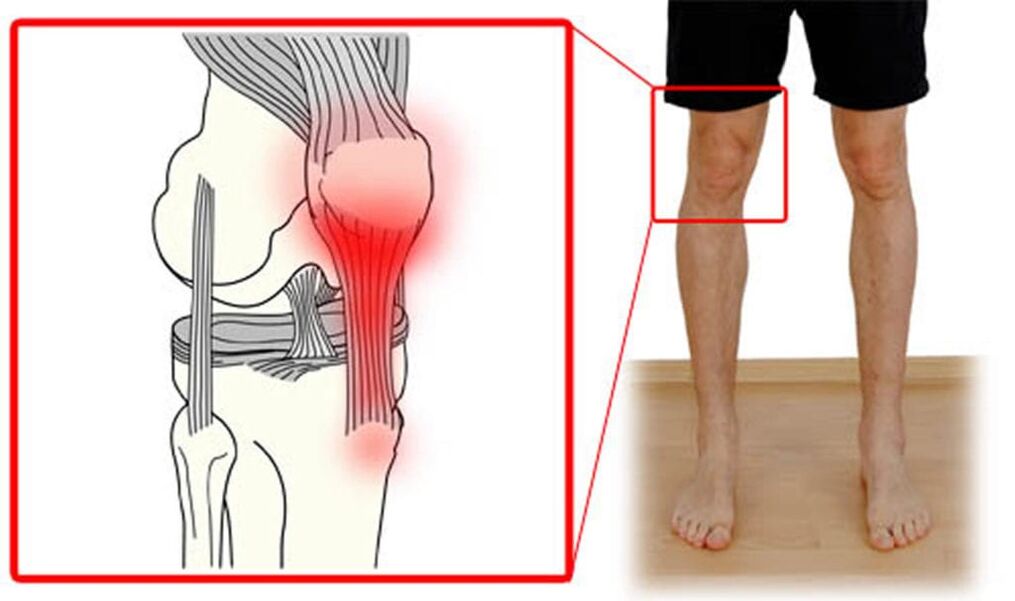 Tendinitis - belauneko artikulazioko tendoien hantura