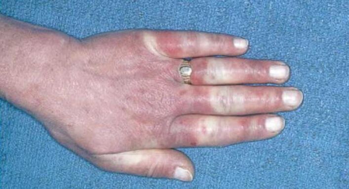 Raynaud-en sindromearen argazki klinikoa - basoespasmoa, hiperemia, edema